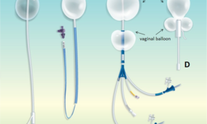 Condom Catheter Sizes